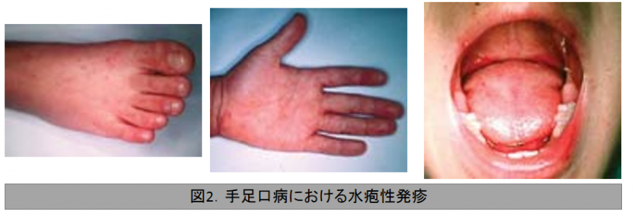 手足口病